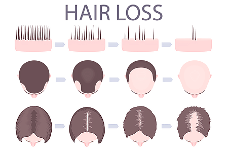 Hair loss
