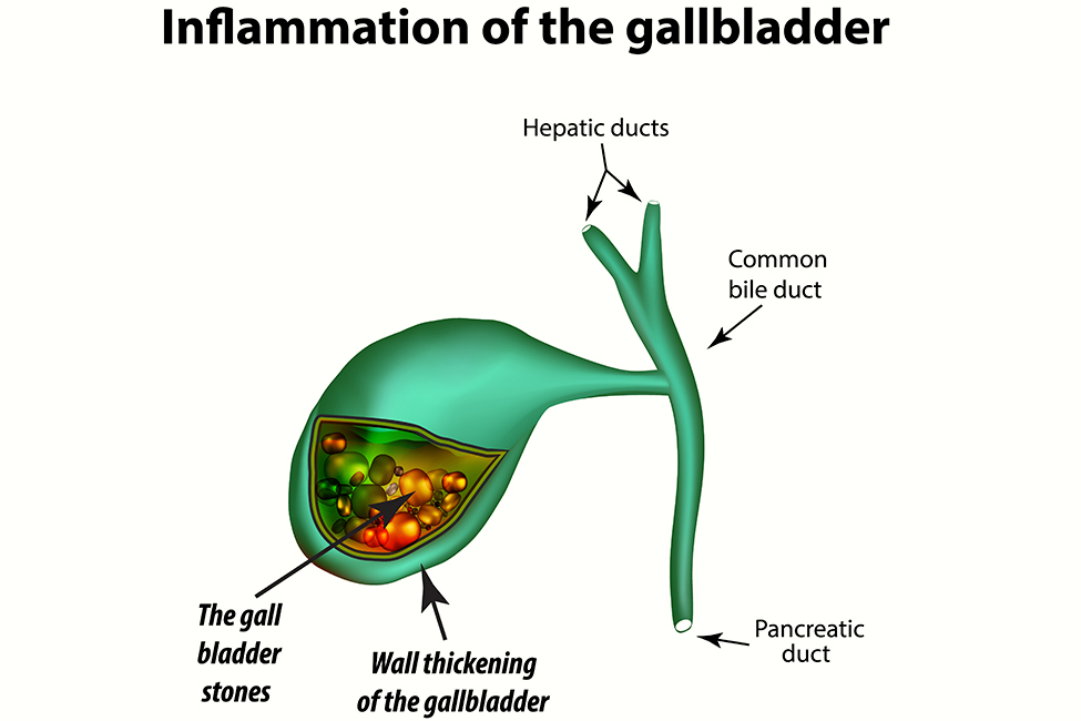 Cholecystitis