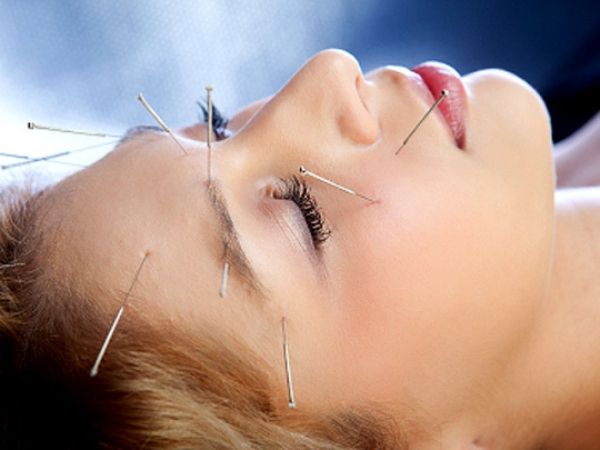 Headache Acupuncture