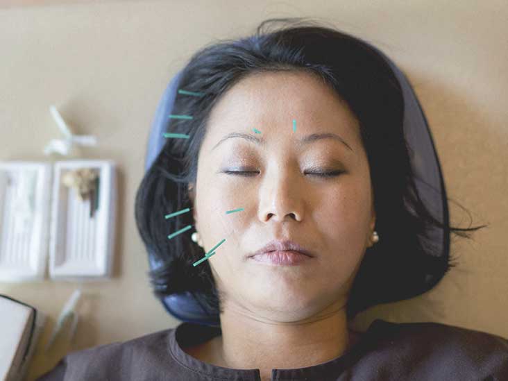 Headaches Acupuncture