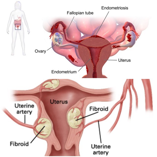Dysmenorrhea