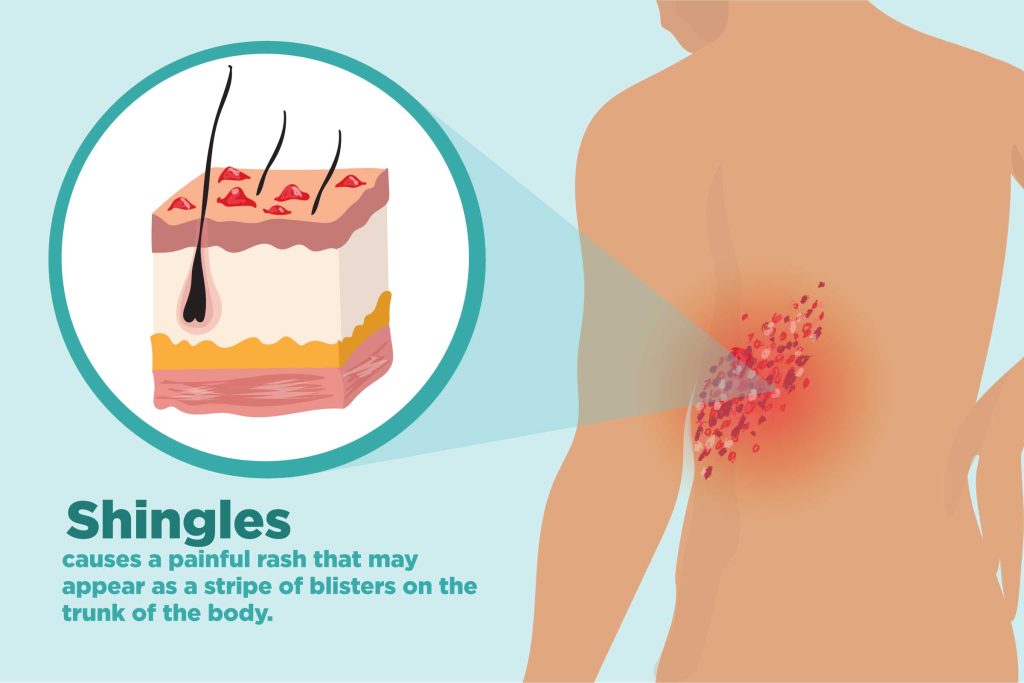 Shingles