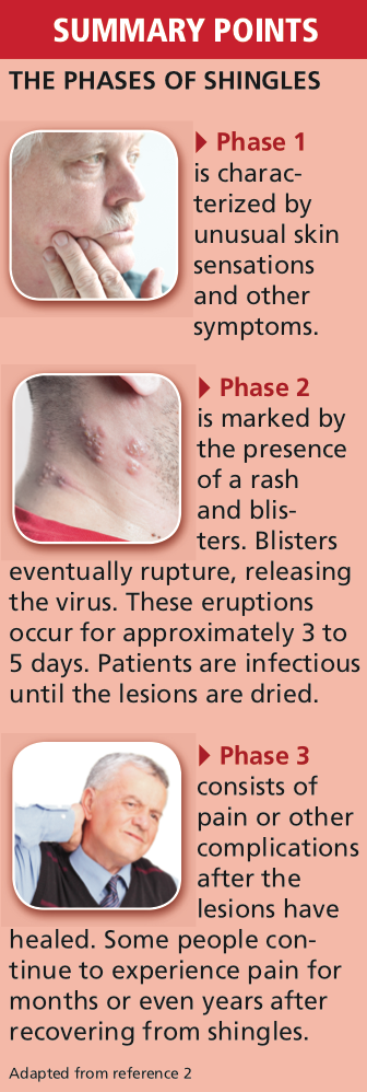 Shingles phases