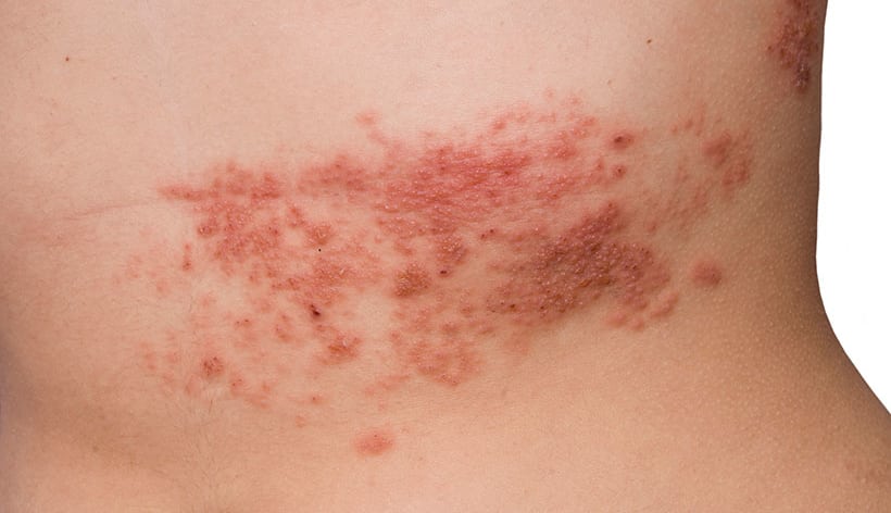 Herpes zoster