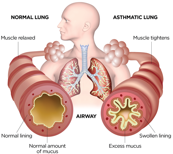 Whata is asthma?