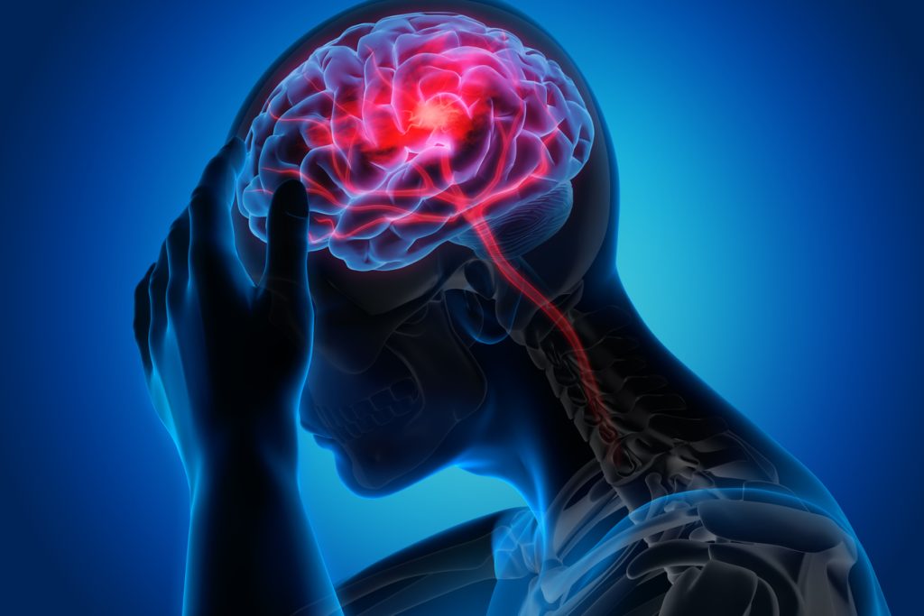 Brain attack