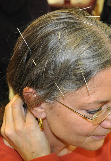 Stroke acupuncture 