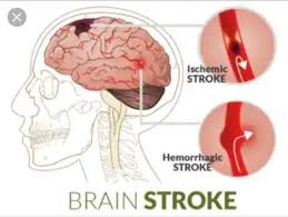 Understanding stroke