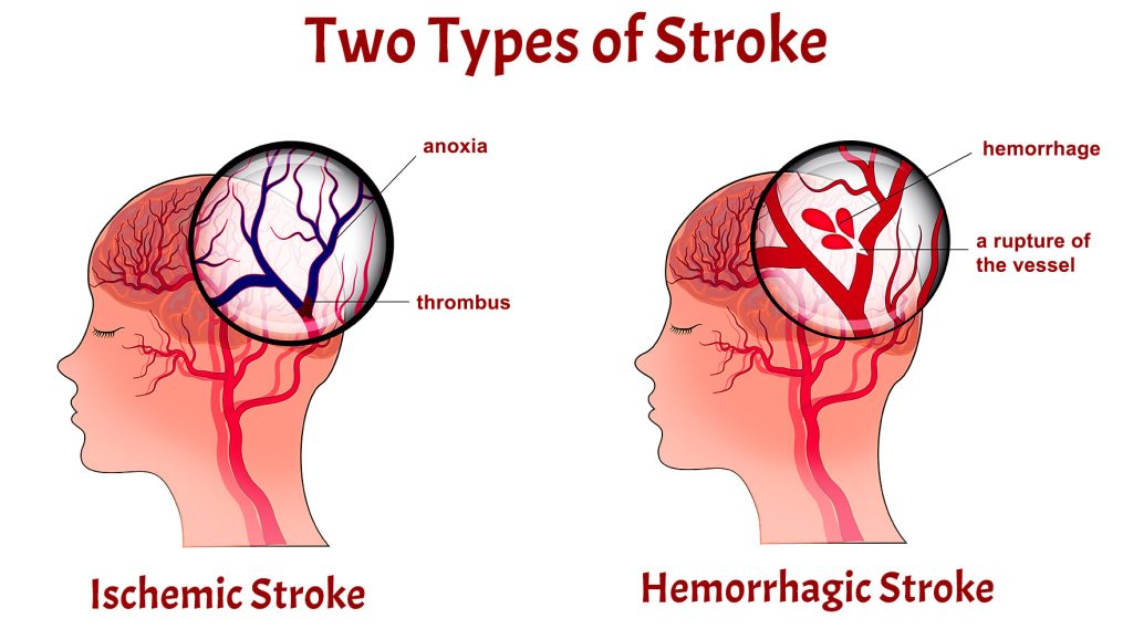 ISCHEMIC AND HEMORRHAGIC BRAIN ATTACK