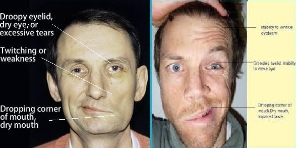 Bell's Palsy