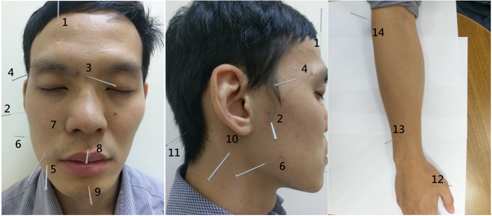 acupuncture