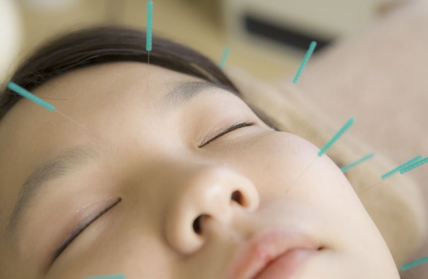 Bell's palsy acupuncture