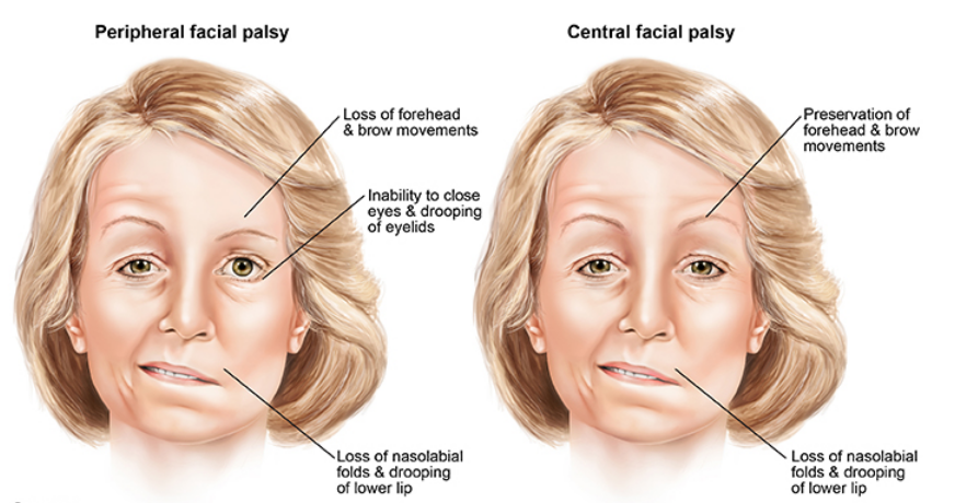 Bells palsy central and periferal 1