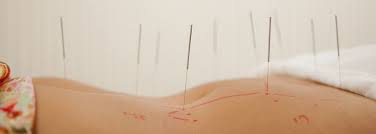 ndometriosis Acupuncture