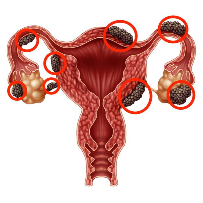 What is Endometriosis