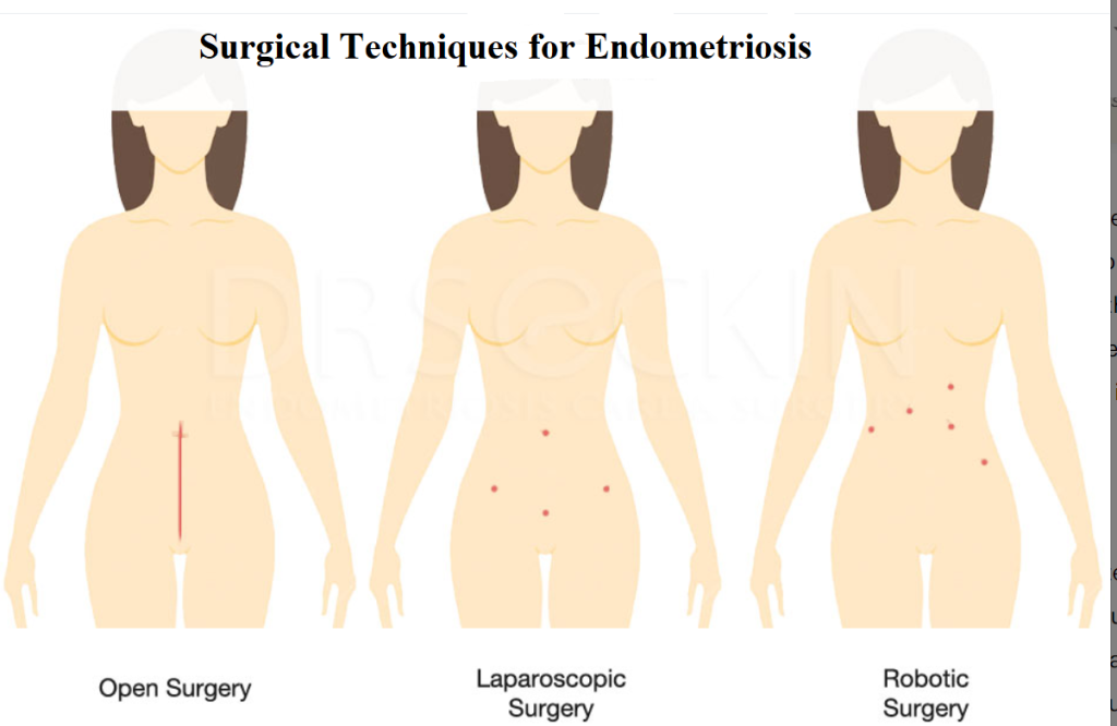 Surgery for Endometriosis