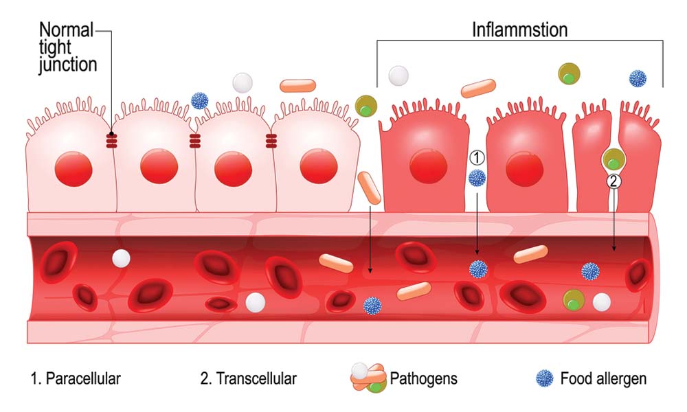Leaky gut pathology