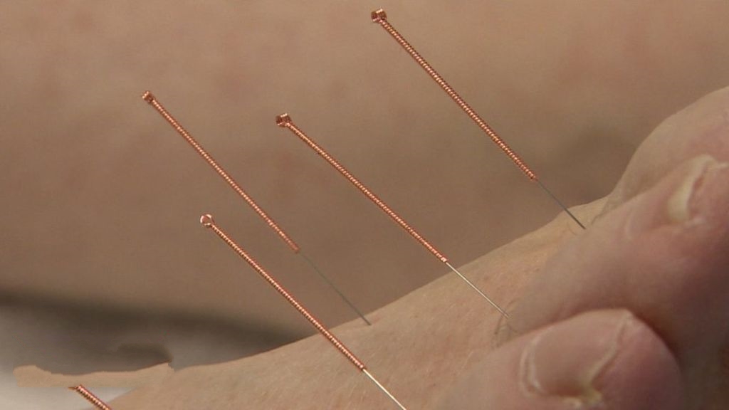 Neuropathy - Acupuncture 
