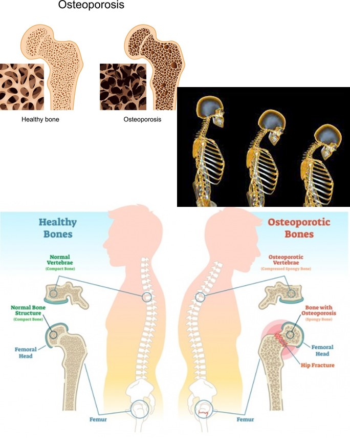 Signs and symptoms of osteoporosis