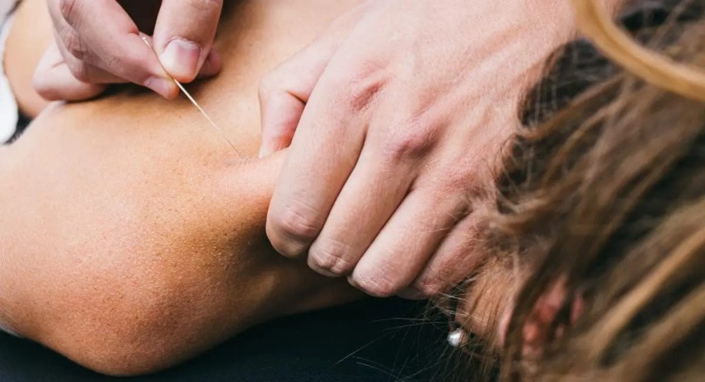 Acupuncture for myofascial pain syndrome