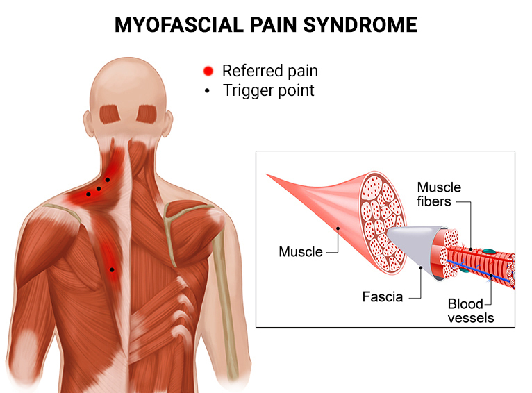 Myofascial Pain Syndrome: Symptoms, Causes, and Treatment