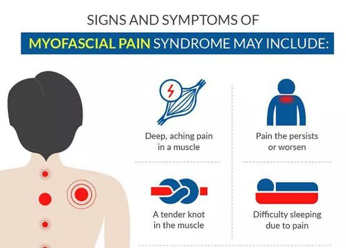Myofascial Pain Syndrome Symptoms