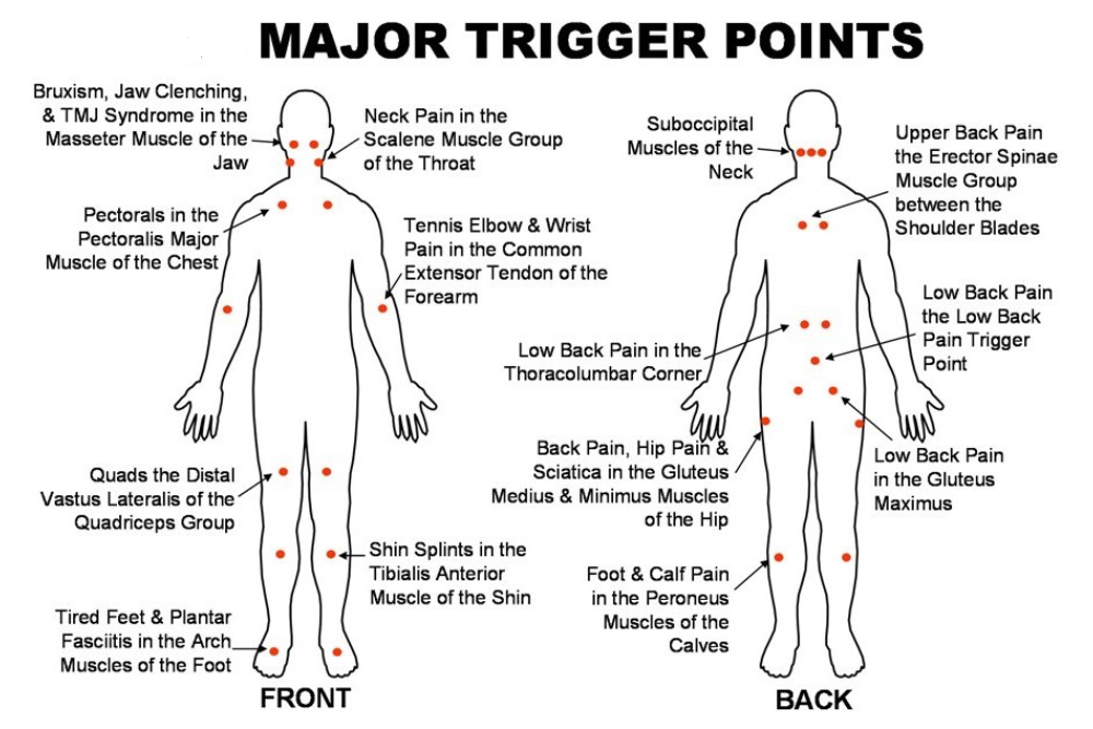 major trigger points