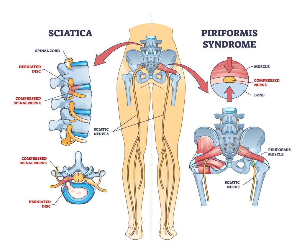 Sciatica vs. Piriformis Syndrome