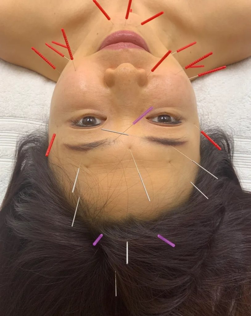 Acupuncture for lazy eyelid