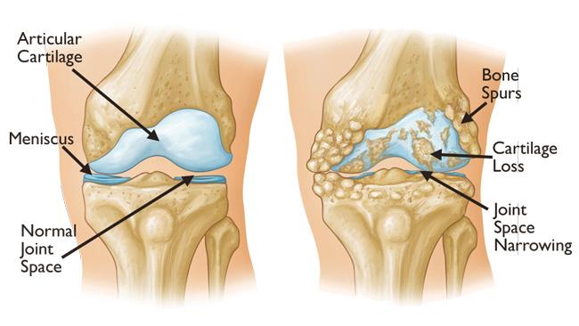 Degenerative Joint Disease