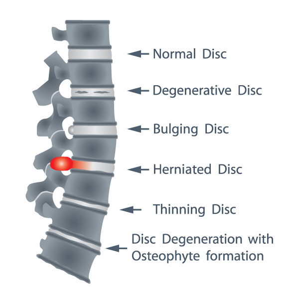 Intervertebral Disc Degeneration