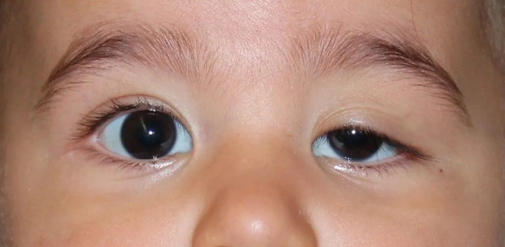 lazy eyelid