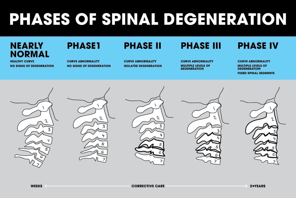 Spinal Degeneration