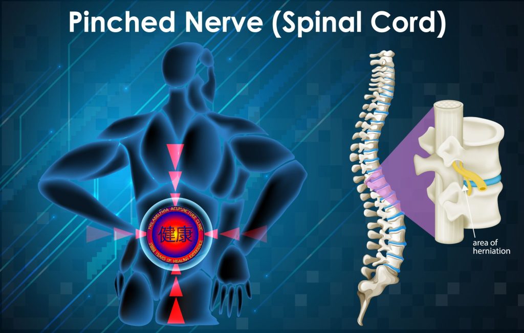 Spinal Stenosis 