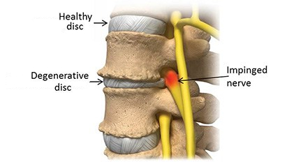 degenerative disc disease DDD