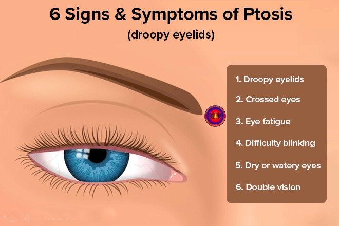 ptosis symptoms