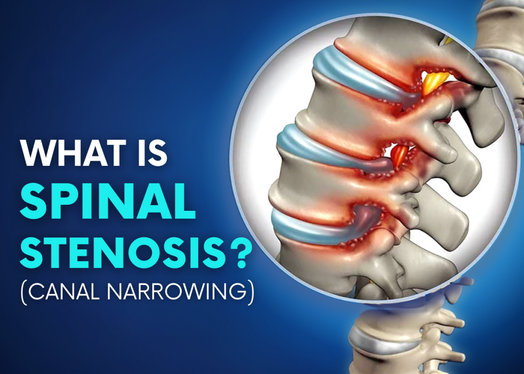  spinal canal narrowing