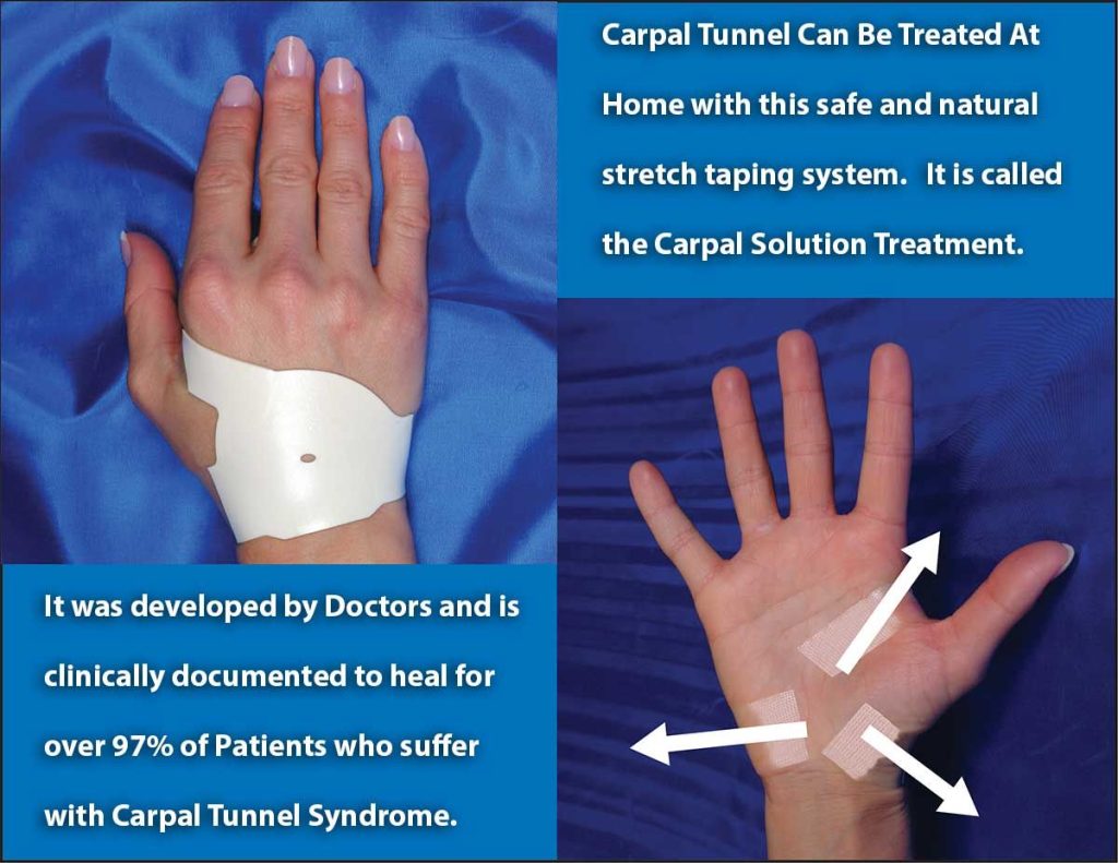 Carpal Tunnel Syndrome