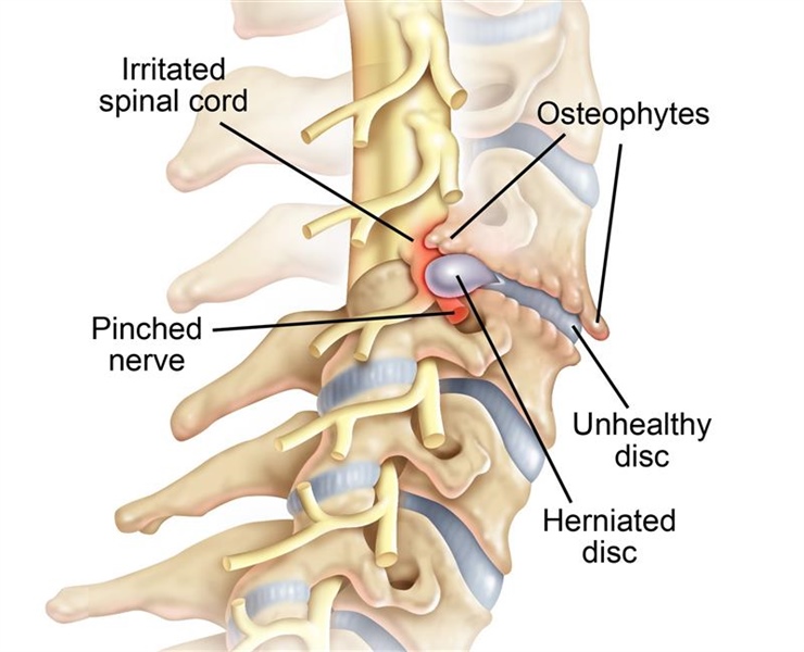Pinched nerve in the cervical spine