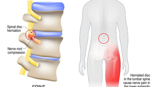 Lumbo-sacral radiculopathy