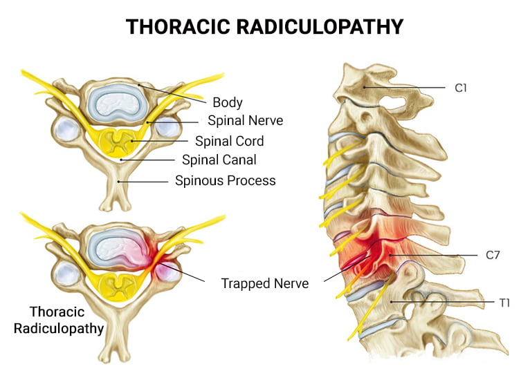 Thoraci Radiculopathy