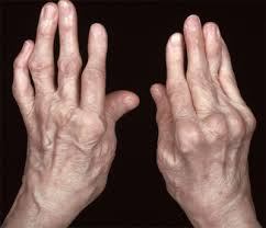 rheumatoid arthritis
