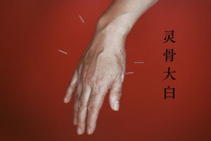 rheumatoid arthritis acupuncture