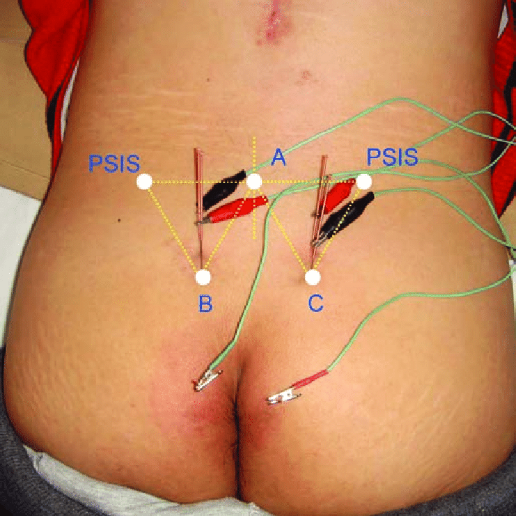 Acupuncture for Cauda Equina Syndrome