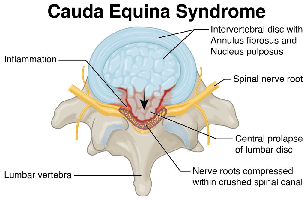 Cauda Equina Syndrome