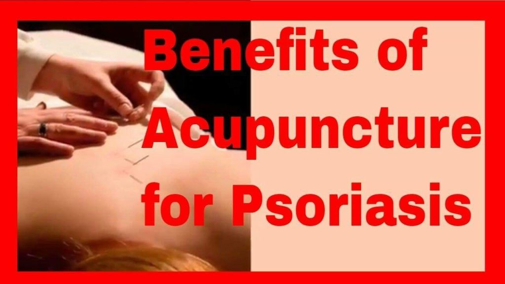 Acupuncture for Psoriasis