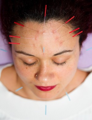 Acupuncture for acne